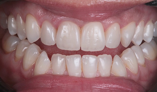 🦷 Aesthetic Restoration of Maxillary Incisors — Natural Beauty and Confidence Restored