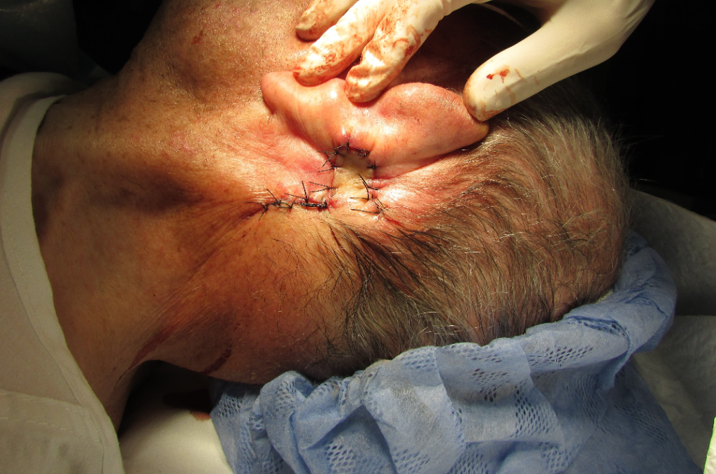 Cirugía dermatológica en Velázquez & Eguren