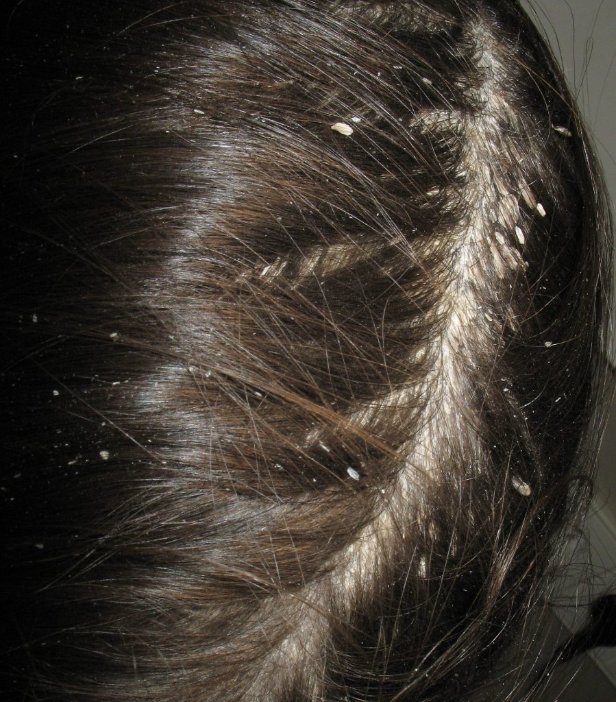 Dermatitis seborreica cuero cabelludo