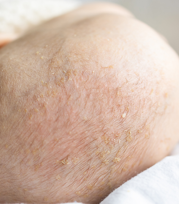Dermatitis seborreica piel