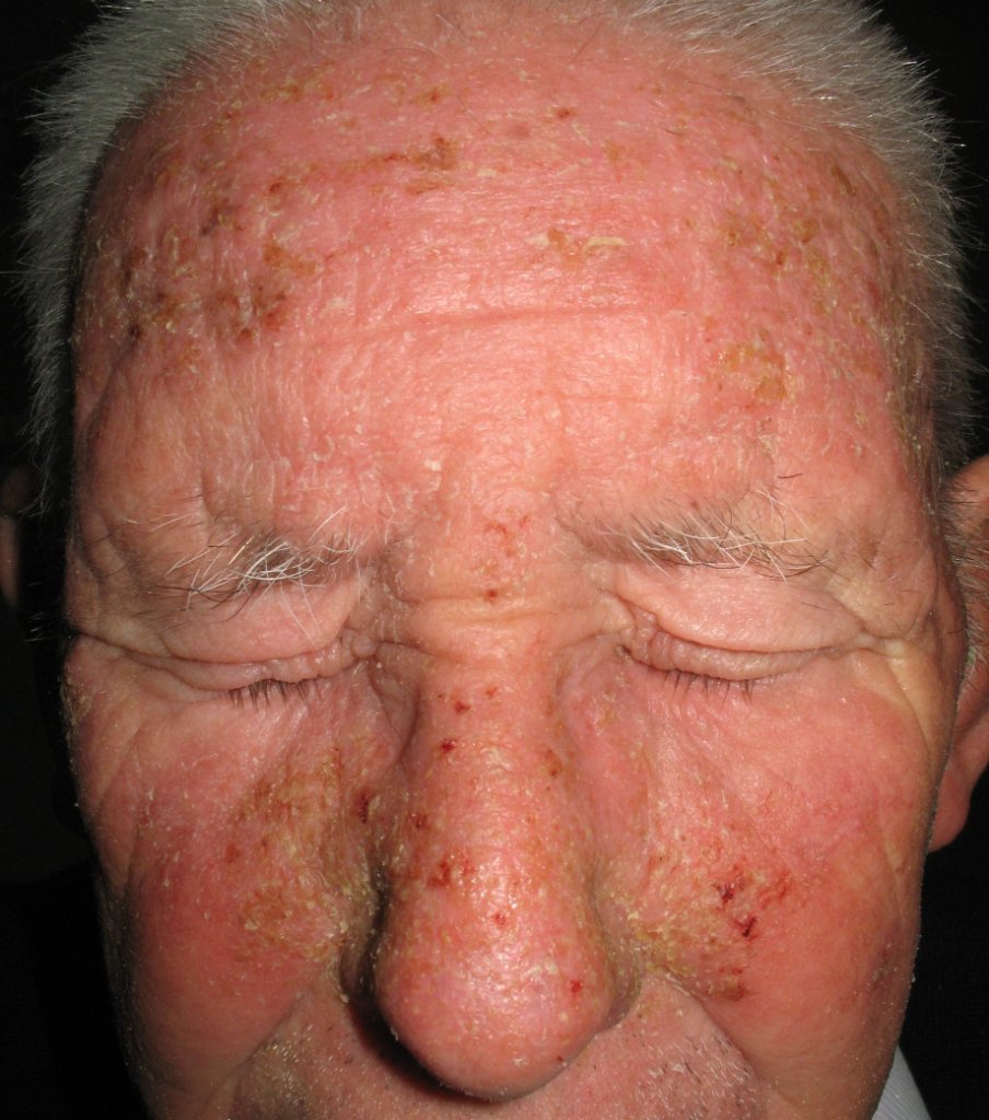 Dermatitis seborreica facial