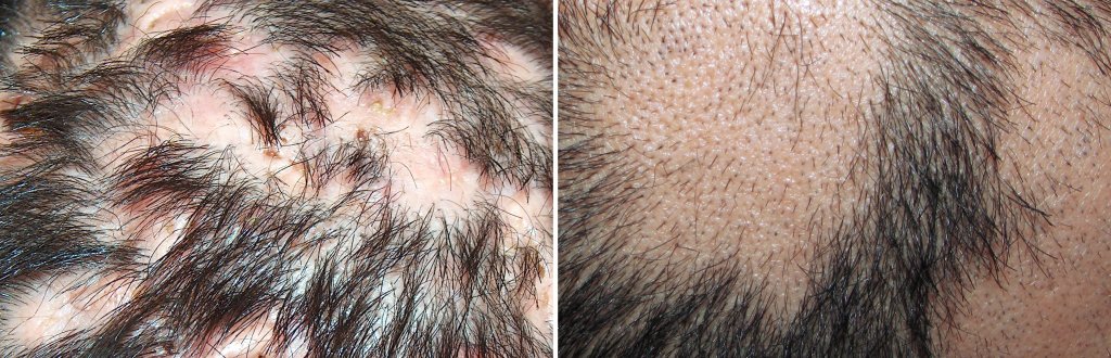 Alopecia cicatricial y no cicatricial — Velázquez & Eguren Dermatología Majadahonda