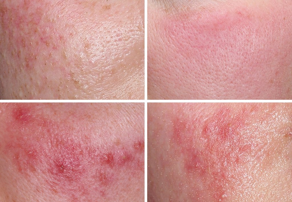 Rosácea variada — Velázquez & Eguren Dermatología Majadahonda