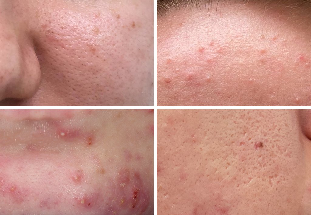 Tipos de acné variado — Velázquez & Eguren Dermatología Majadahonda