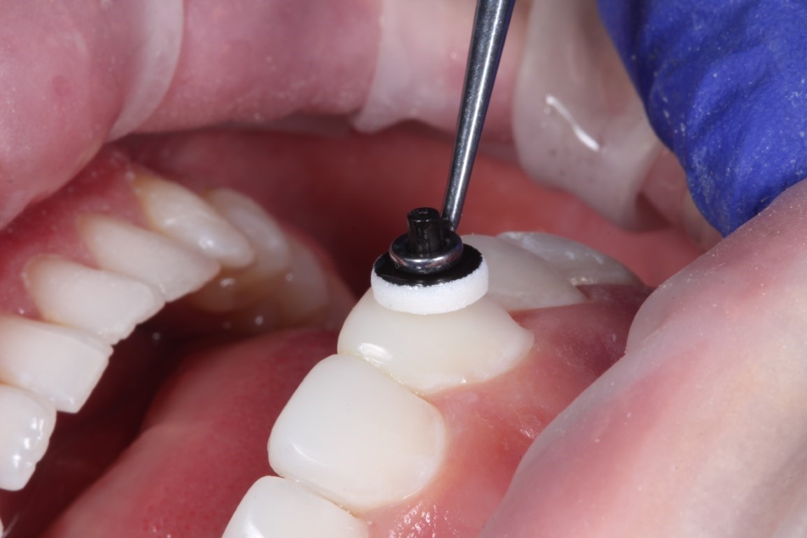 Composite Bonding