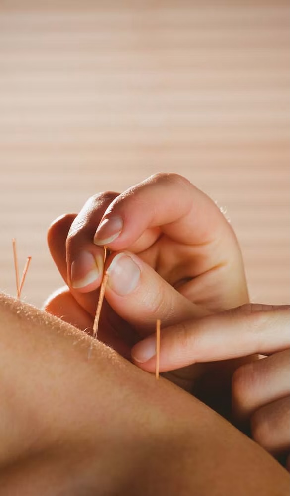 Acupuncture needling
