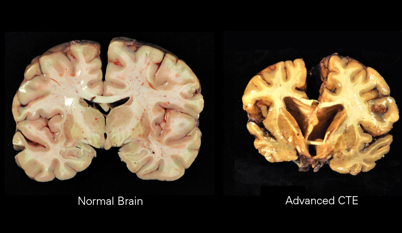 CTE brain comparison