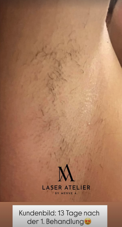 Ergebnis 13 Tage nach der 1. Diodenlaser-Behandlung
