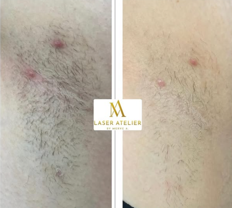 Vorher & Nachher – Achselzone Laserbehandlung Kornwestheim