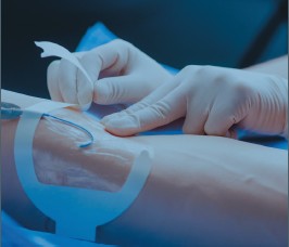 IV catheter fixation with transparent dressing