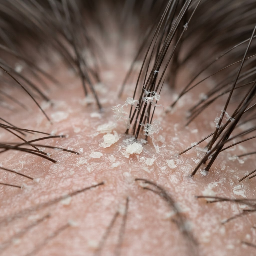 Visible Flaking — magnified scalp research photograph