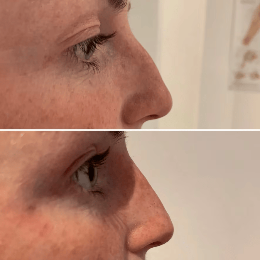 Dermal Fillers