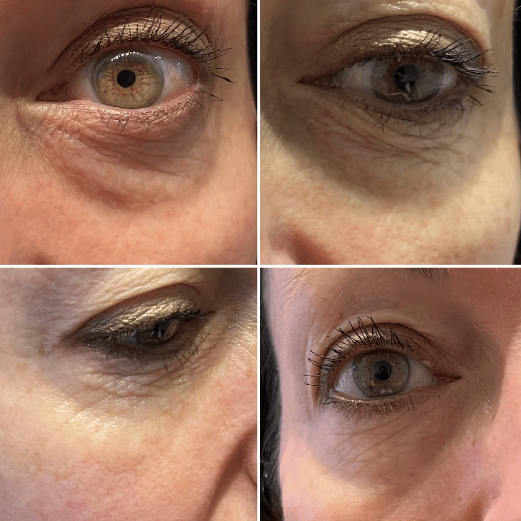 Skin Boosters — Periocular Rejuvenation