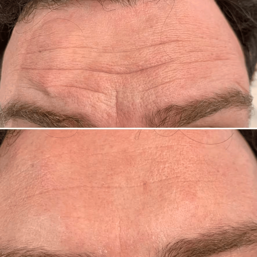 Anti-Wrinkle