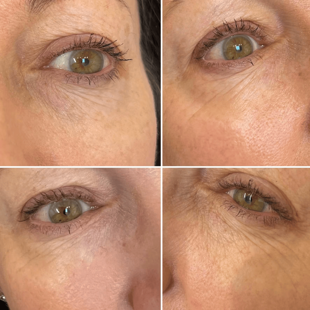 Skin Boosters — Periocular Rejuvenation