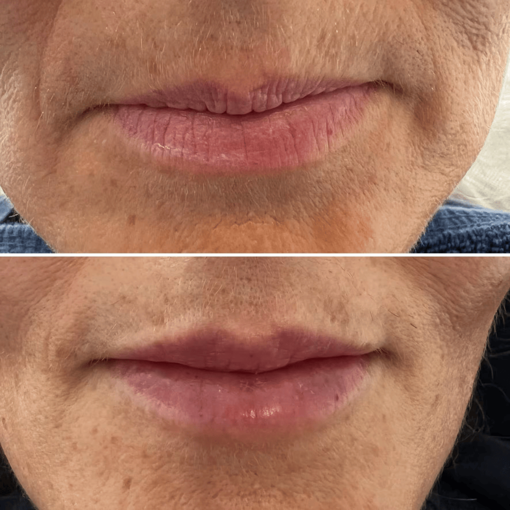 Dermal Fillers