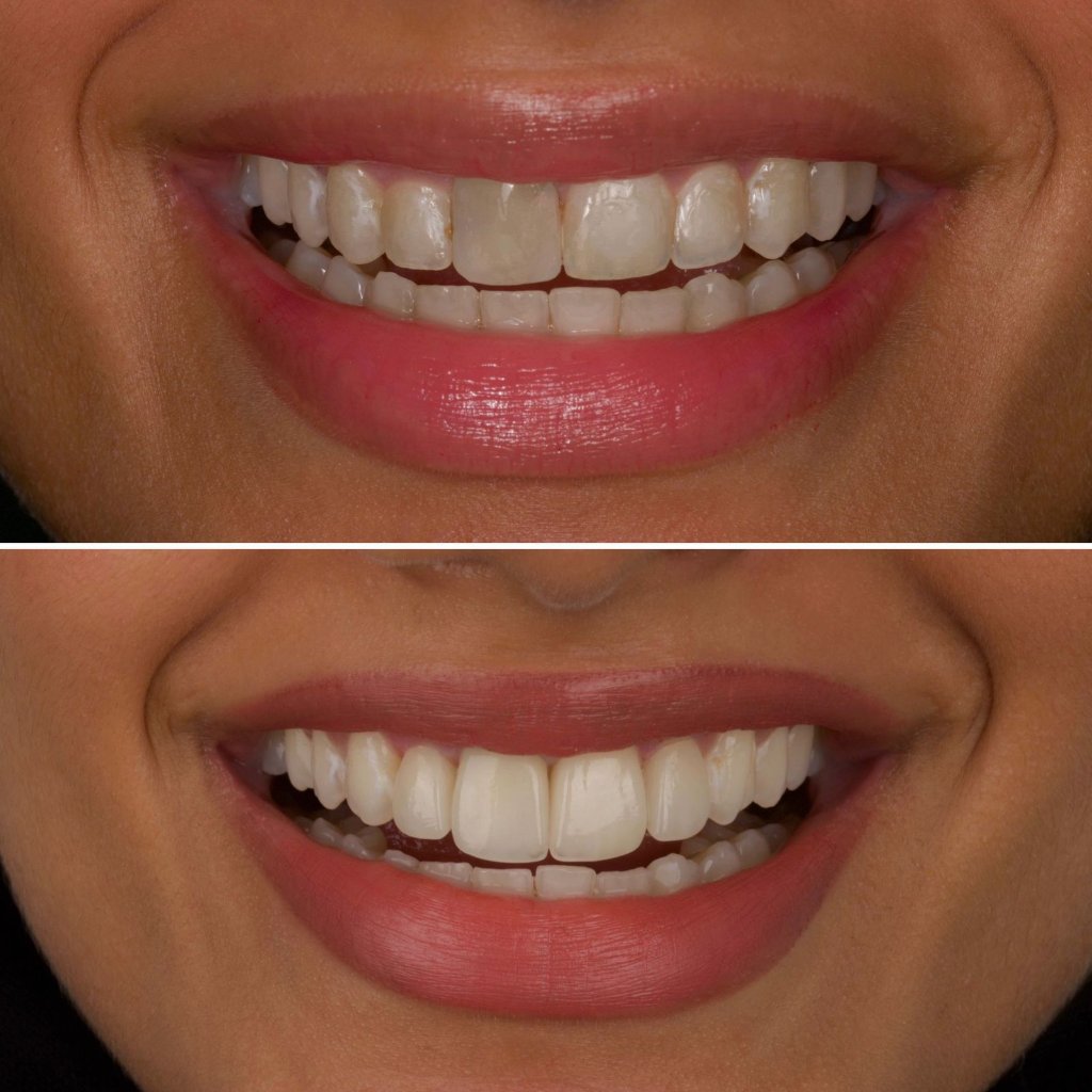 Smile Enhancement - After