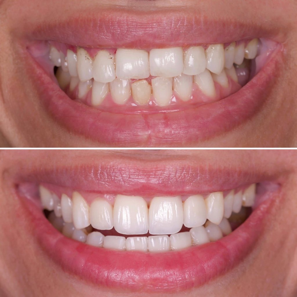 Smile Enhancement - Before