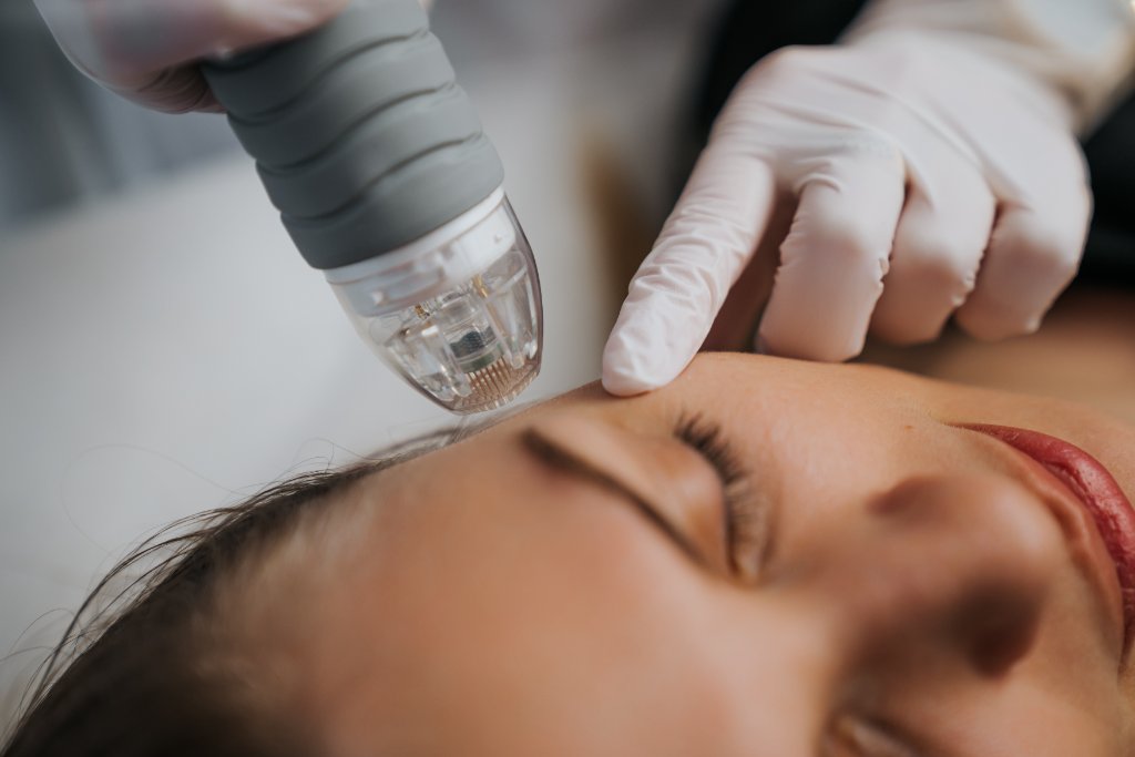 Microneedling