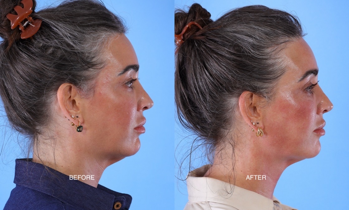 XERF before after thumbnail 7