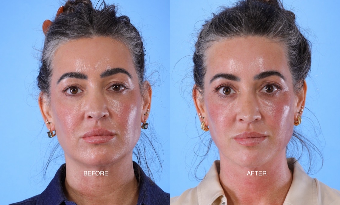 XERF before after thumbnail 4