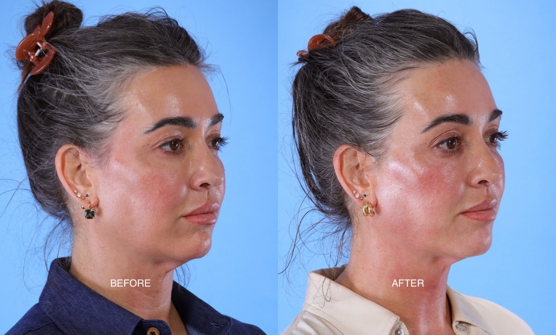 XERF before after thumbnail 5