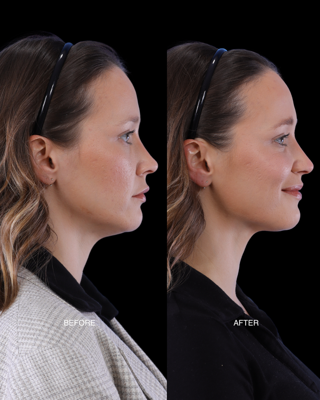 XERF before after thumbnail 2