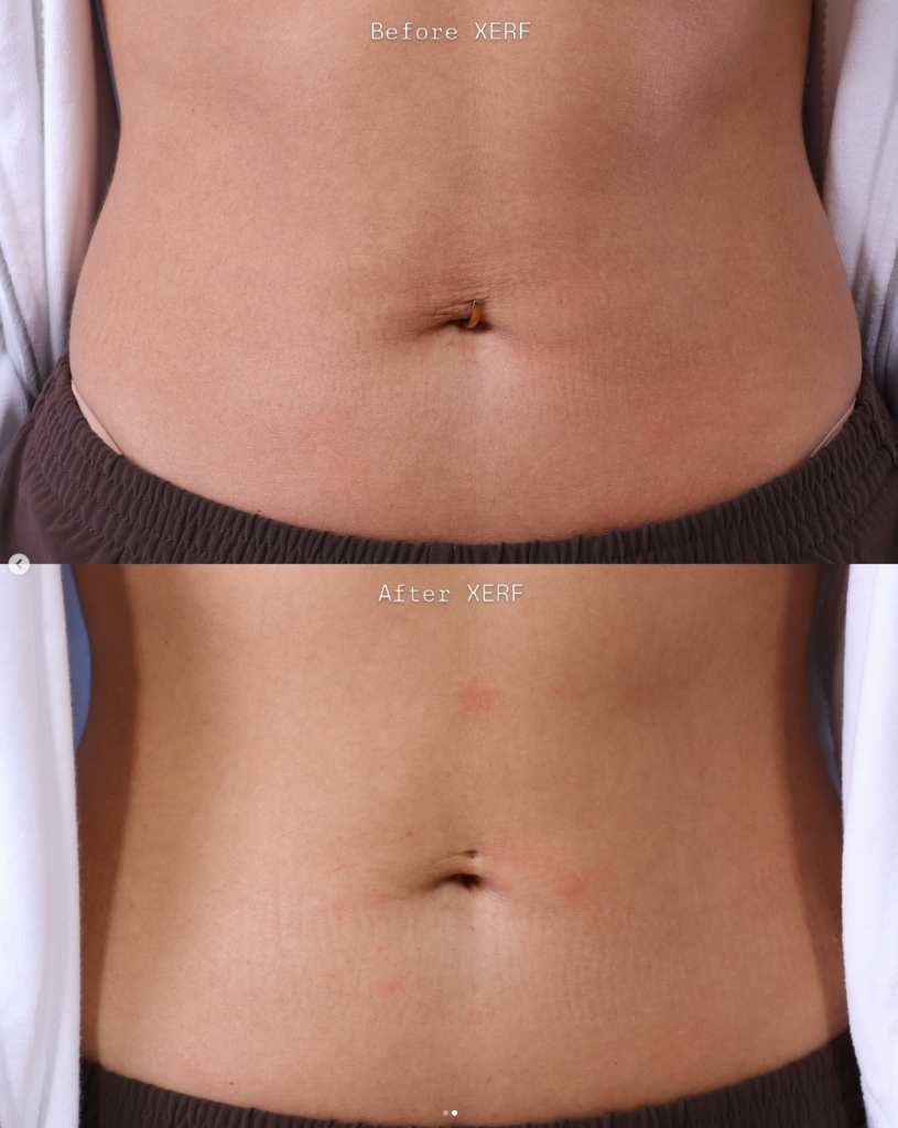 XERF before and after — ABDOMEN