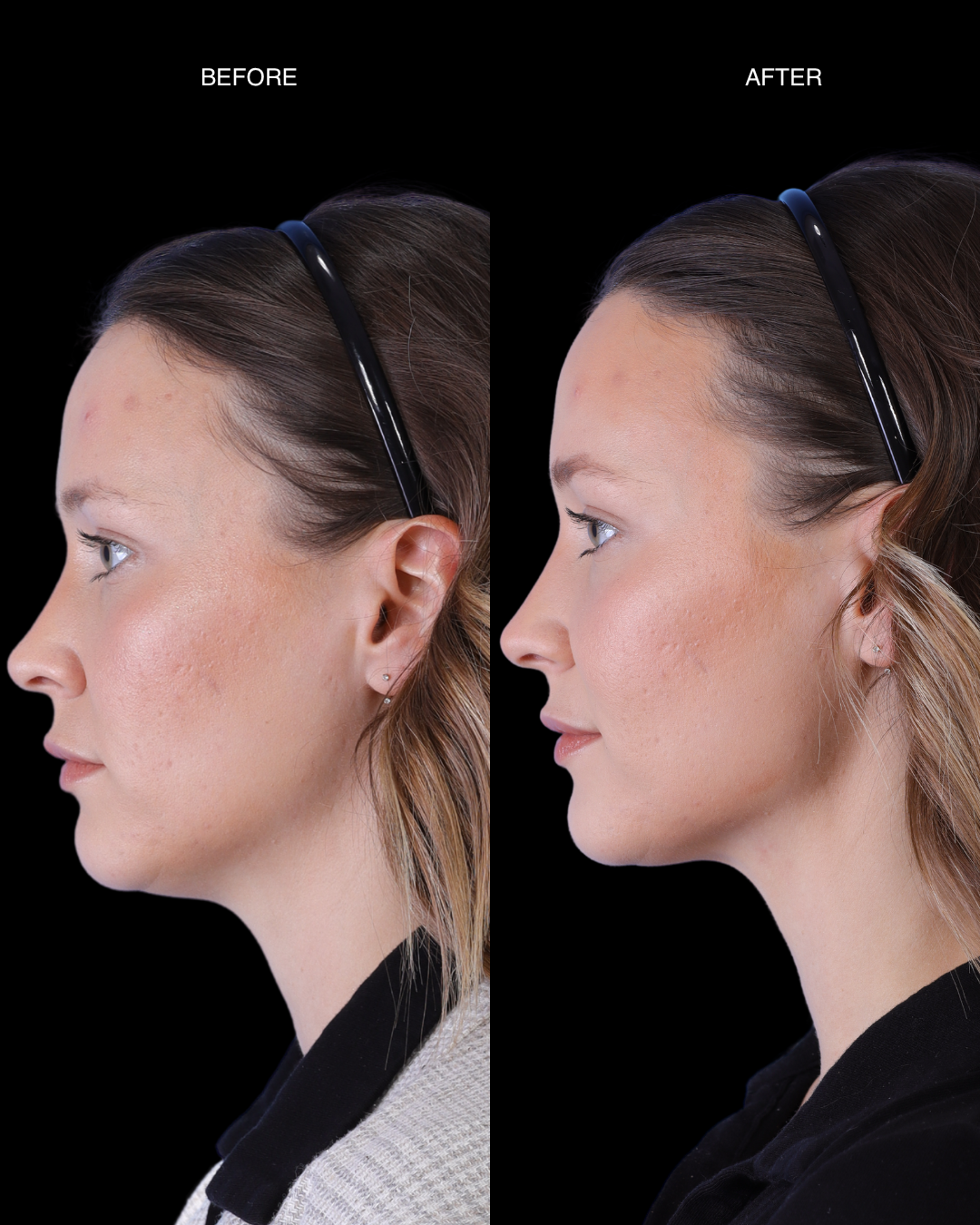 XERF before and after — PROFILE — LEFT