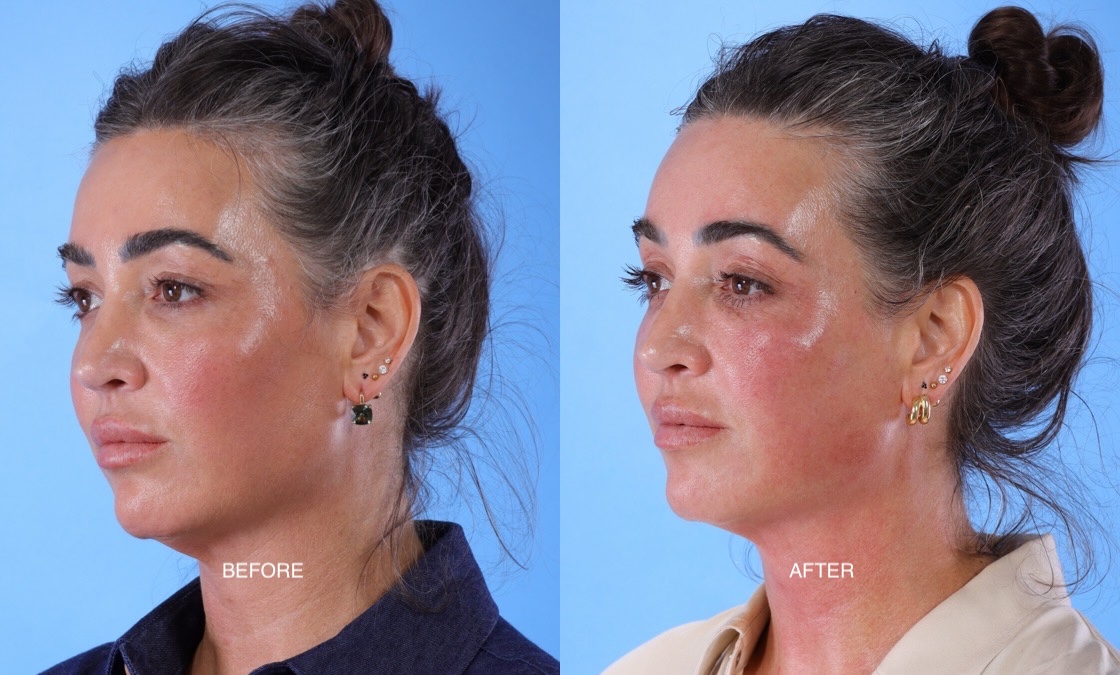 XERF before after thumbnail 6