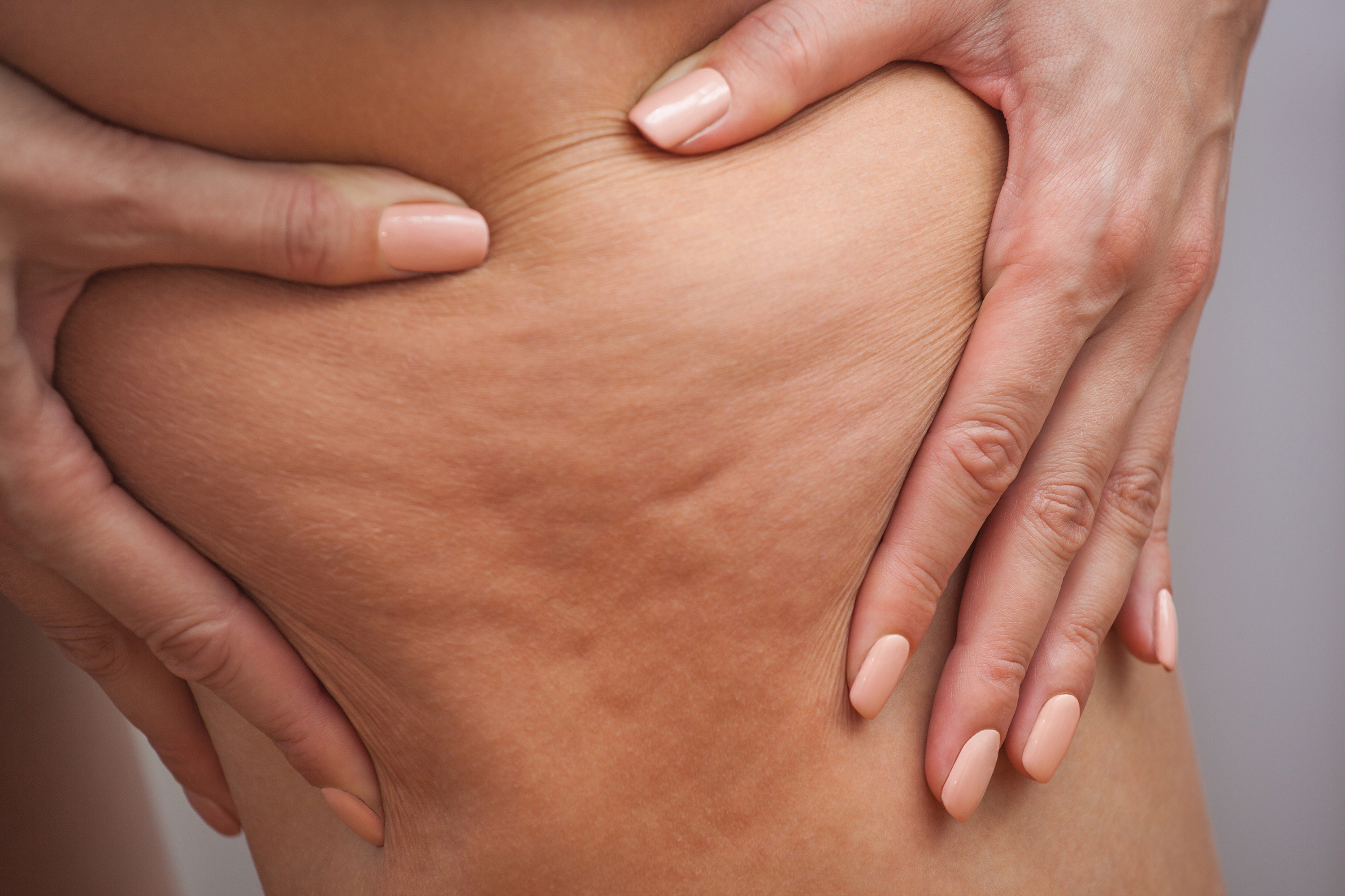 Cellulite adipeuse