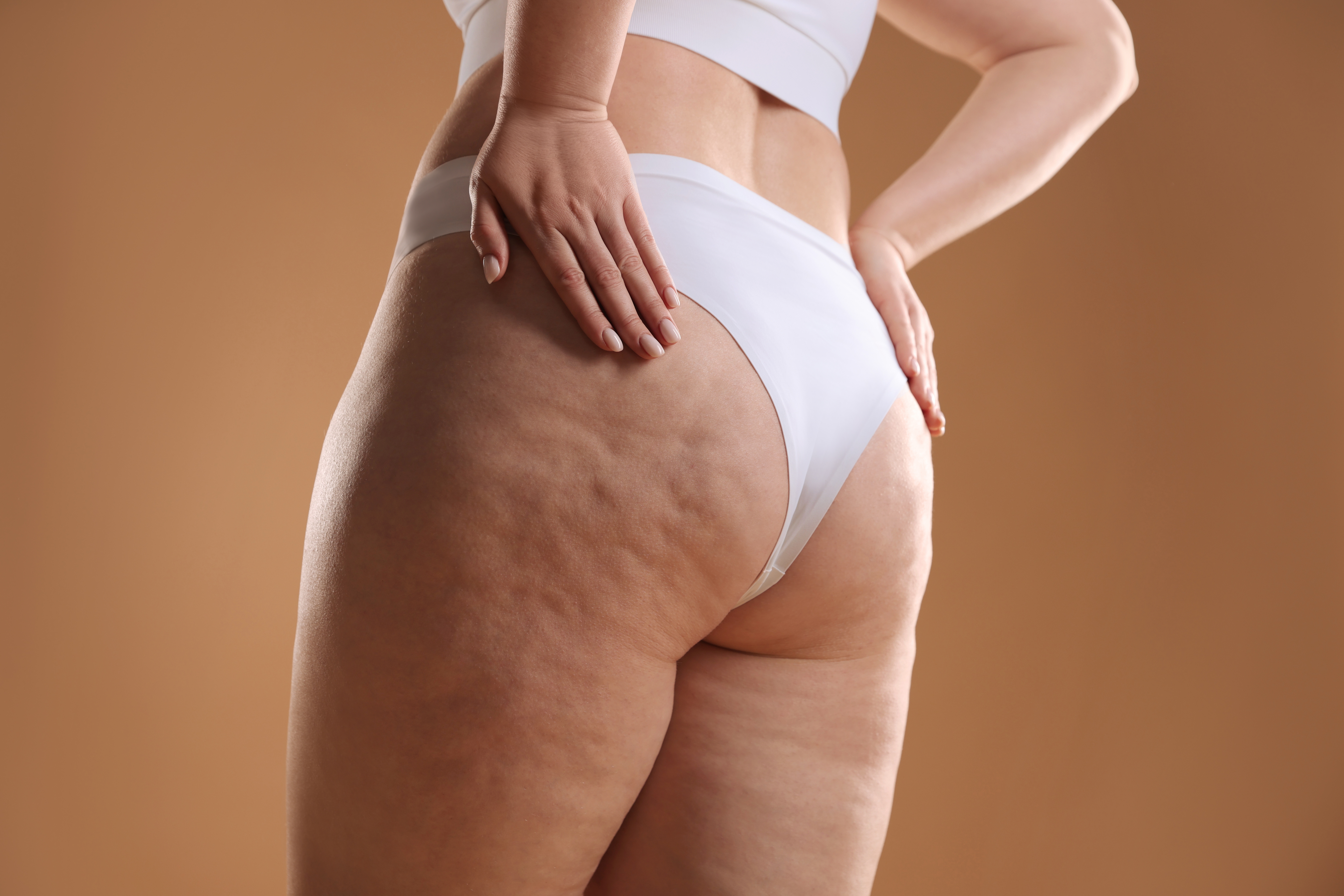 Cellulite fibreuse