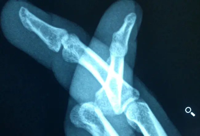 Fractures & Dislocations