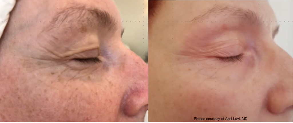 Pigmentation treatment result after 2 Tixel sessions