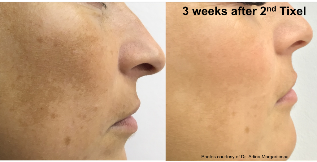 Melasma treatment: 3 weeks after 2nd Tixel session
