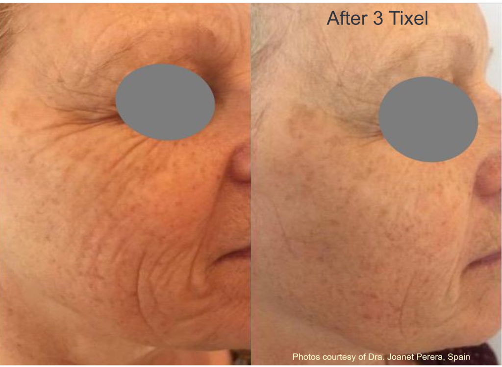 Wrinkle reduction after 3 Tixel sessions