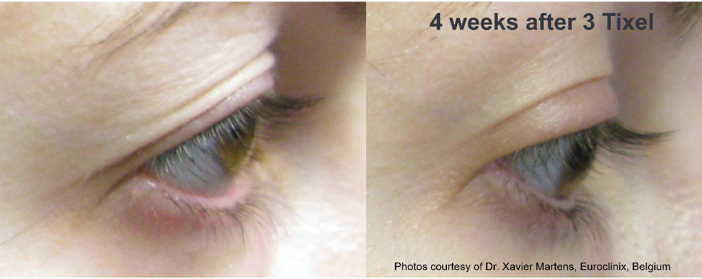 Eye area rejuvenation: 4 weeks after 3 Tixel sessions