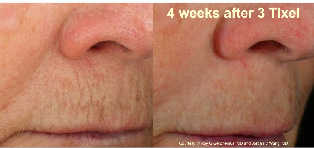 Lip lines treatment: 4 weeks after 3 Tixel sessions