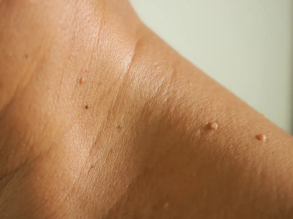 Skin Tag & DPN Removal