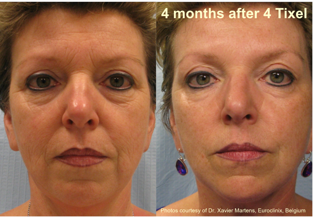 Wrinkle reduction: 4 months after 4 Tixel sessions