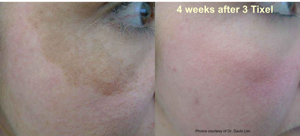 Melasma treatment: 4 weeks after 3 Tixel sessions