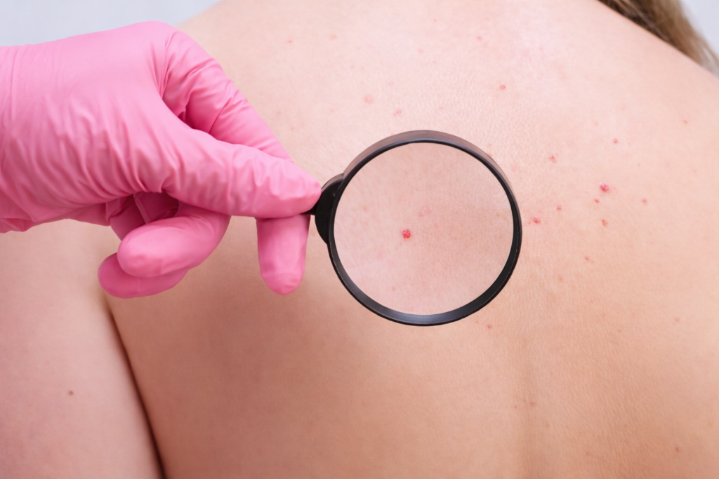 Vascular Lesions & Cherry Angioma Removal