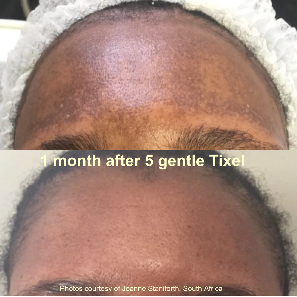 Pigmentation treatment: 1 month after 5 gentle Tixel sessions