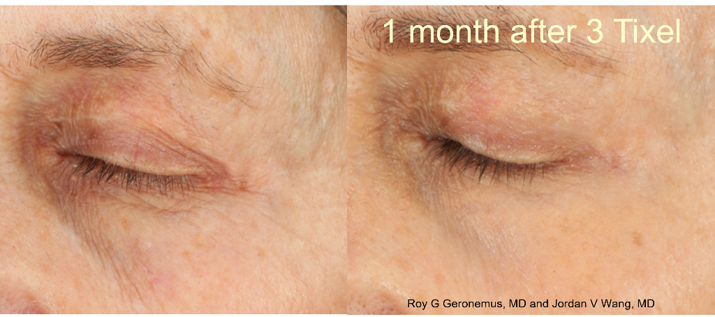 Eye area rejuvenation: 1 month after 3 Tixel sessions