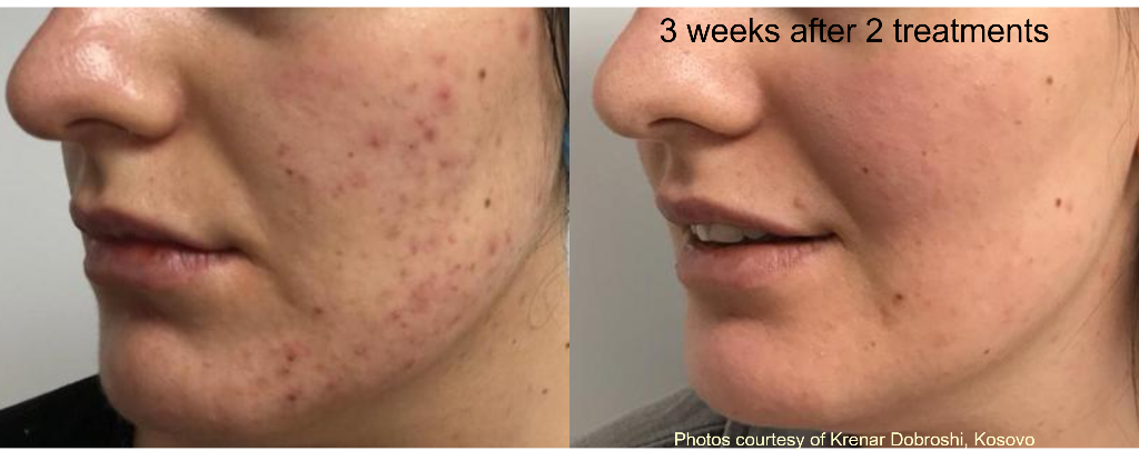 Acne treatment result: 3 weeks after 2 Tixel sessions