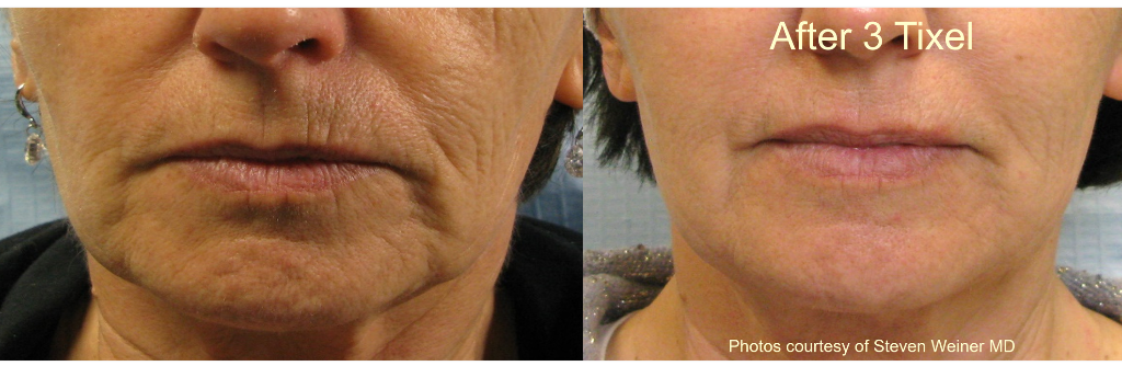 Lip lines treatment result after 3 Tixel sessions