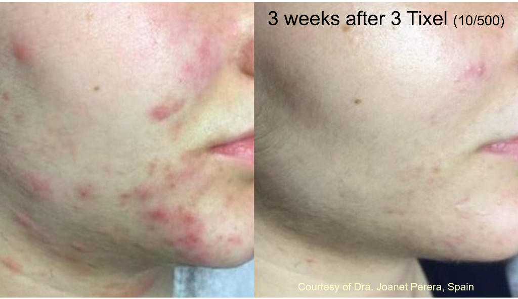 Acne treatment result: 3 weeks after 3 Tixel sessions