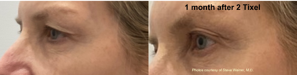 Eye area rejuvenation: 1 month after 2 Tixel sessions