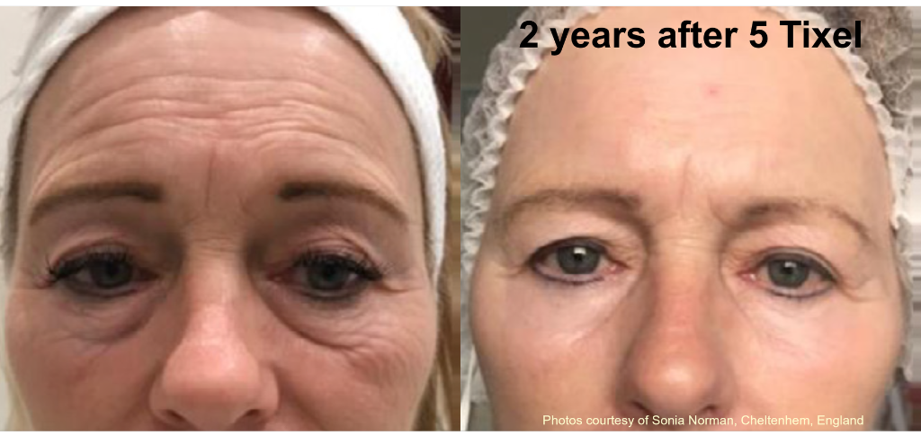 Wrinkle reduction: 2 years after 5 Tixel sessions