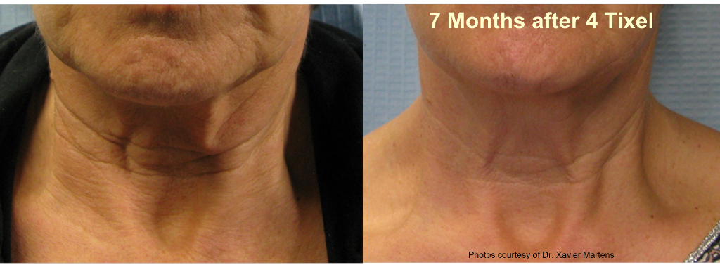 Neck rejuvenation: 7 months after 4 Tixel sessions